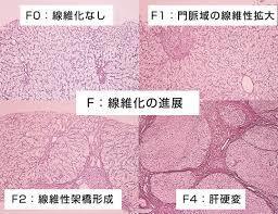 肝硬変・線維化の組織図